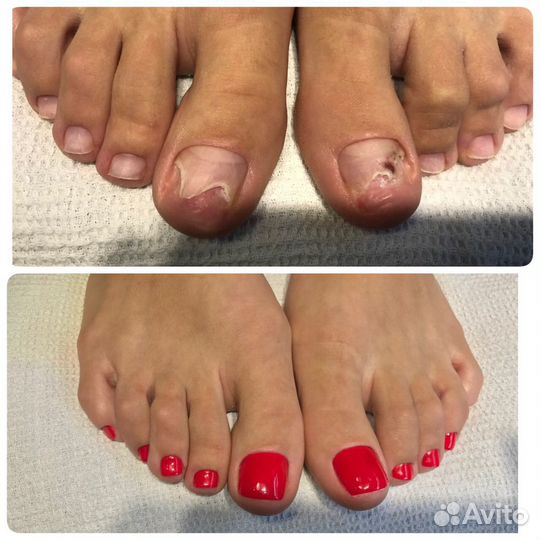 Лечебный педикюр Подолог