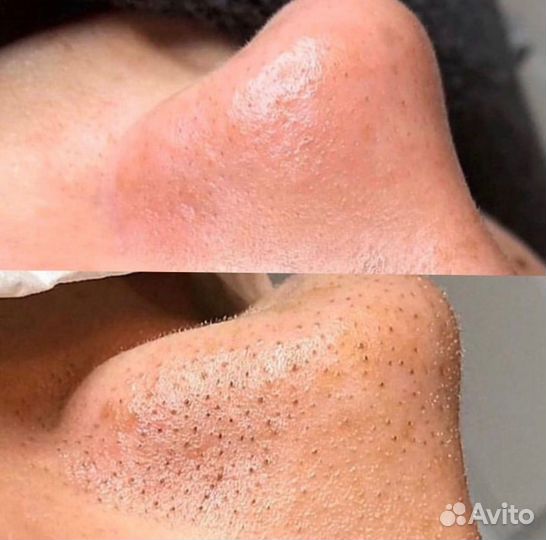 Чистка лица, пилинг, уход, на премиум препаратах