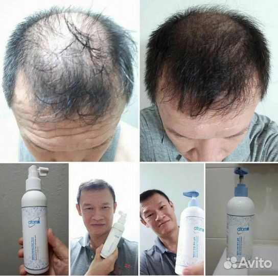 Спрей от выпадения волос Атоми Корея