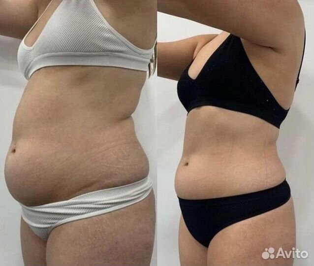 Криолиполиз