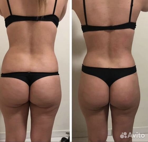 Антицеллюлитный массаж и коррекция фигуры