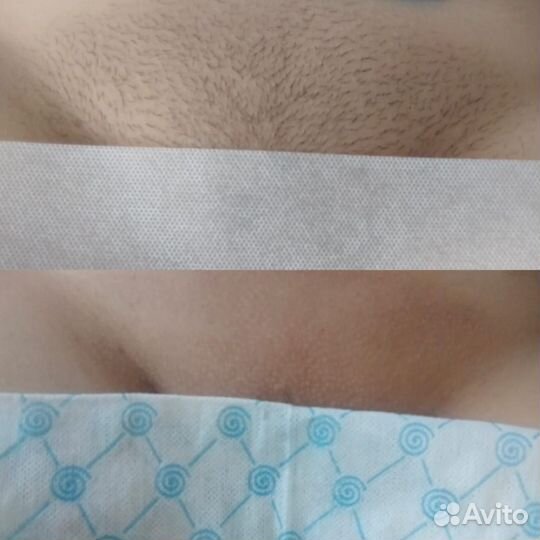 Депиляция воском