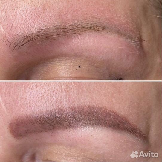 Лазерное удаление татуажа, перманента, тату