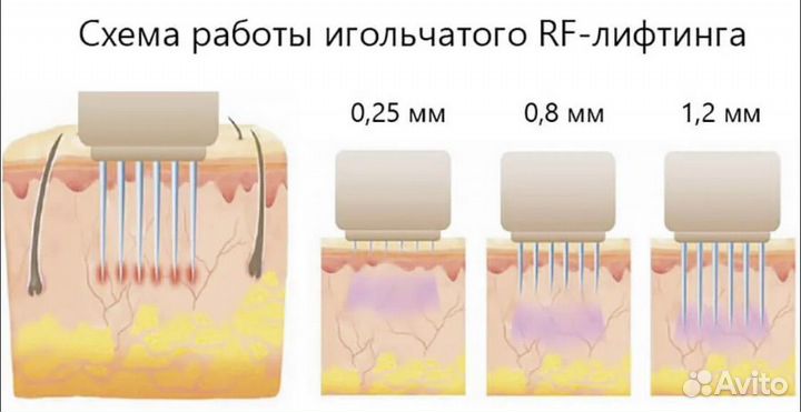 Микроигольчатый RF лифтинг лица и тела