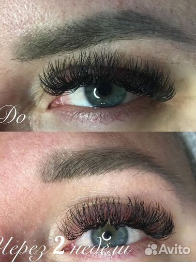 Удаление татуажа ремувером