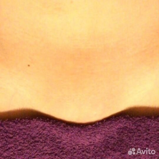 Лазерная эпиляция