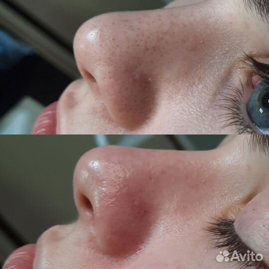 Чистка лица