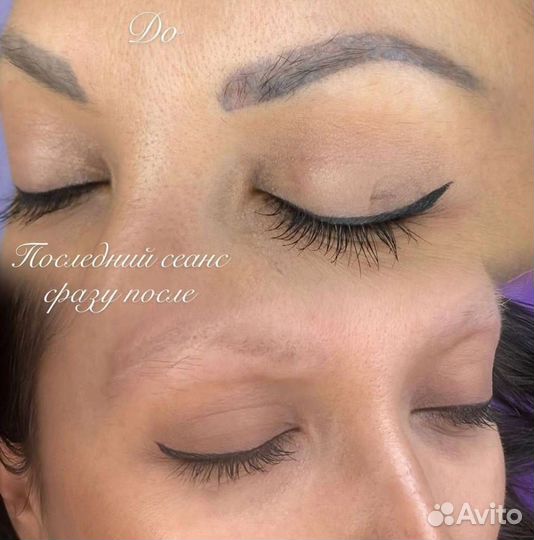 Удаление татуажа