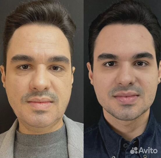 Подтяжка лица за 1 процедуру. СМАС лифтинг