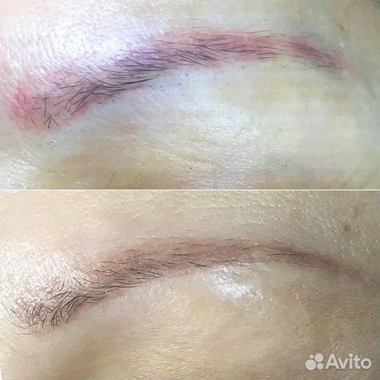 Удаление татуажа ремувером