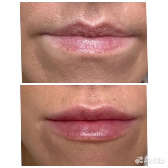 Увеличение губ