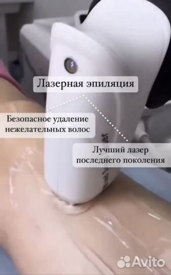 Лазерная эпиляция