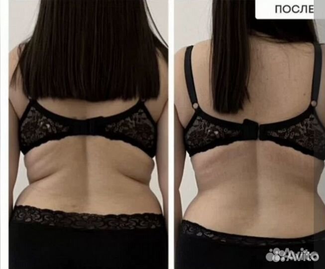 Криолиполиз