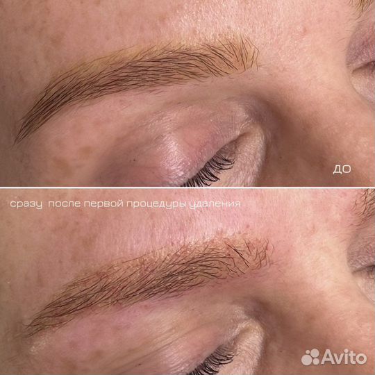 Удаление татуажа ремувером revivink plus ревайвинк