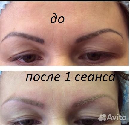Удаление тату,татуажа