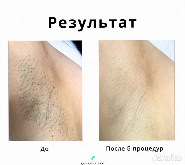 Диодный лазер Lumines-M MaxOne 1200в