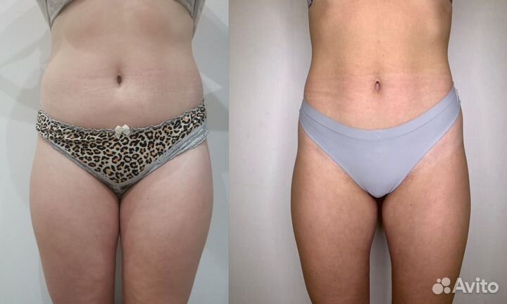 LPG массаж / авторская методика / гарант.результат