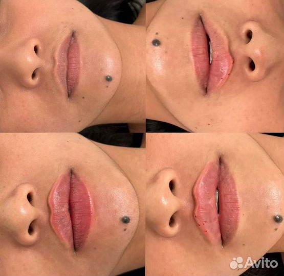 Губы, Ботокс. Full Face Требуются модели