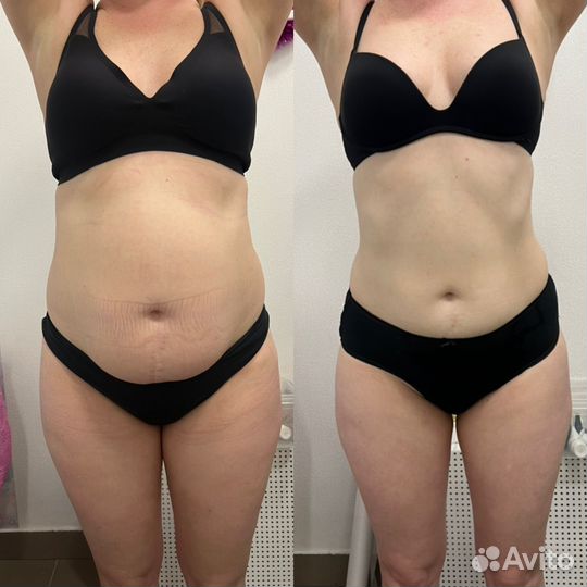 Вакуум Кавитация RF лифтинг Миостимуляция