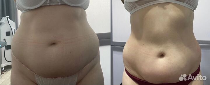 Коррекция фигуры