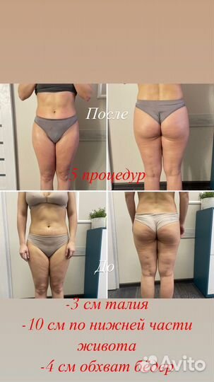 Антицеллюлитный аппаратный массаж