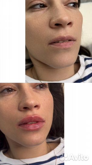 Врач косметолог. Увеличение губ. Ботокс