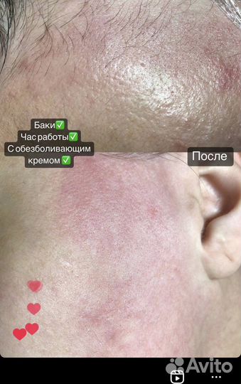 Электроэпиляция