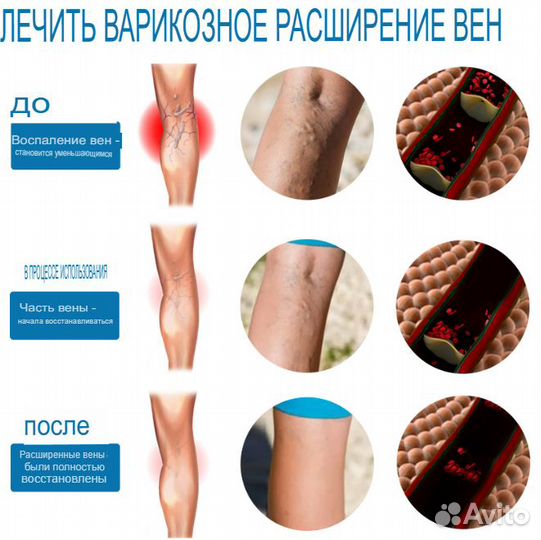 Спрей от варикозного расширения вен, 30 м