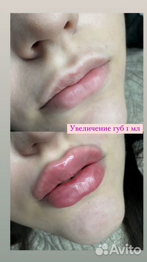 Увеличение губ