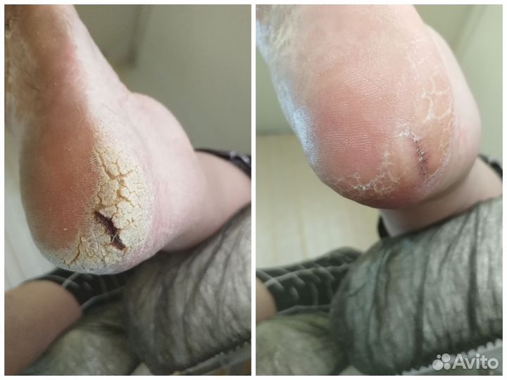 Подолог. Парамедицинский педикюр