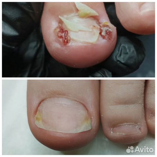 Педикюр, подолог