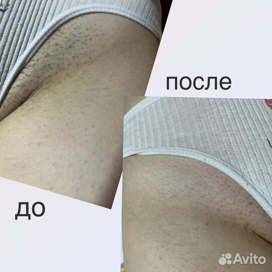 Депиляция воском