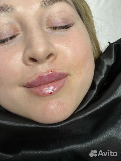 Контурная пластика губ