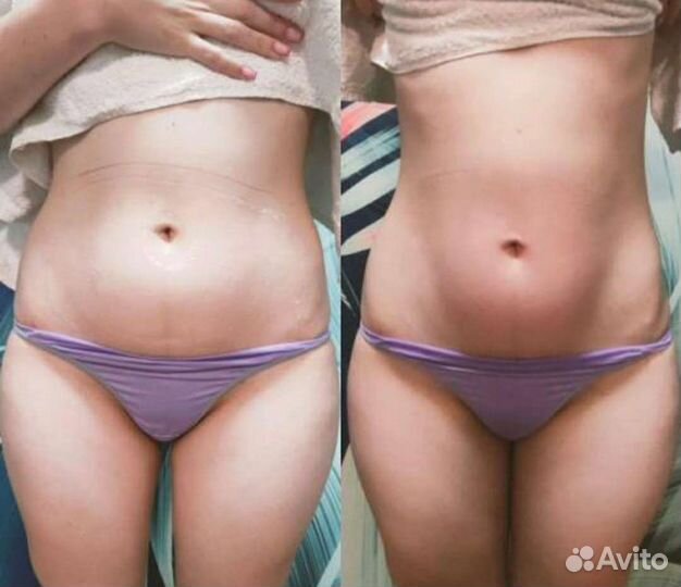 Жиросжигающая процедура Индиба