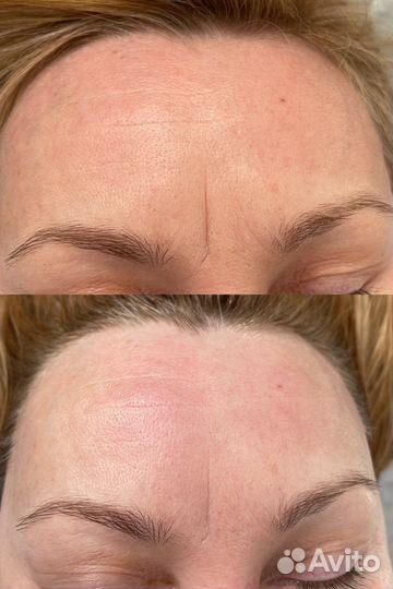 Скульптурно-буккальный массаж лица