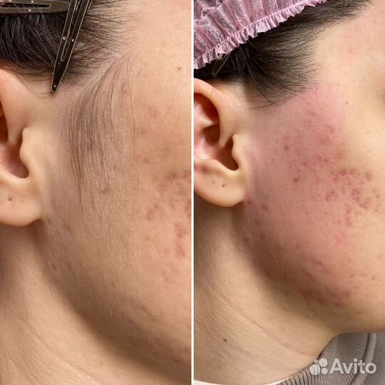 Восковая депиляция/Ставрополь/Парафинотерапия