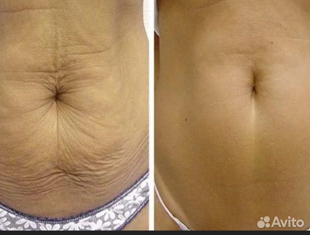 Липосакция без операции