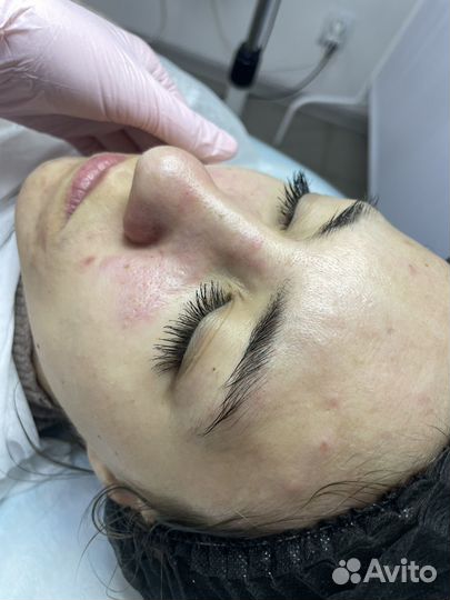 Чистка лица