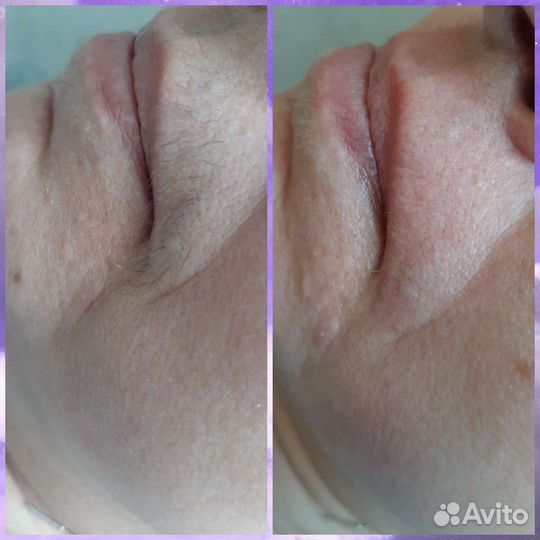 Шугаринг Фитоэпиляция