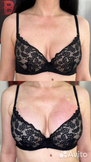 Увеличение ягодиц/ груди/ интимная пластика