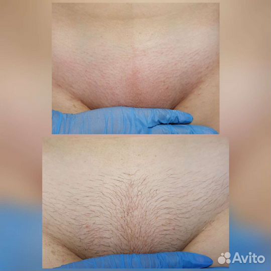 Восковая депиляция(мужская/женская)