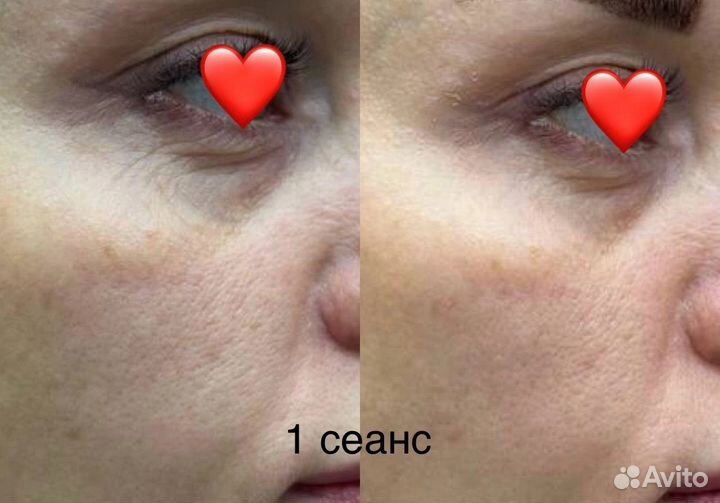 Омоложение лица / лифтинг лица