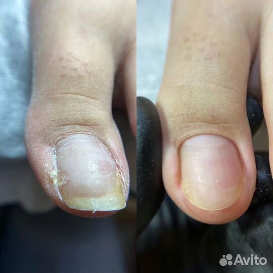 Медицинский педикюр (подология )