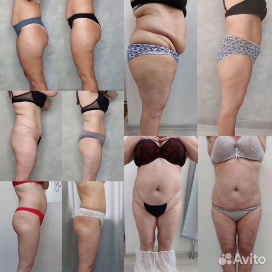 Аппаратный массаж, аппаратная коррекция фигуры