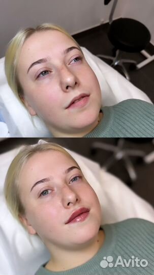 Увеличение губ