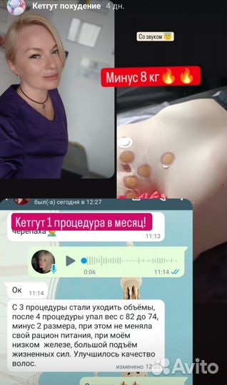 Кетгут похудение