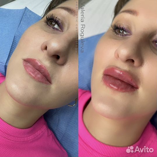 Модель на увеличение губ