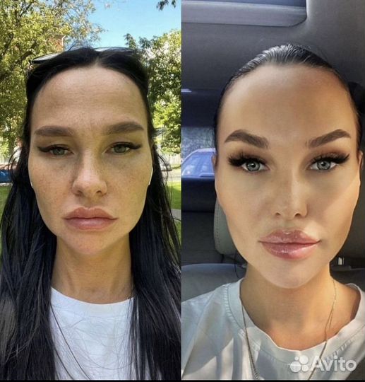 Красивый лифтинг бровей (нити, ботокс)