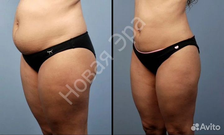 Убрать живот, сбросить вес. Заморозка жира