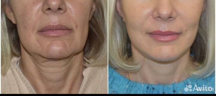 Биоревитализация,Пилинг,коллаген чистка,липолитики